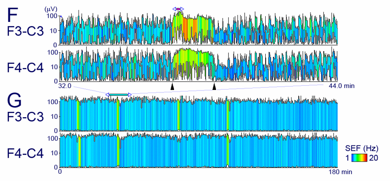 長時間脳波記録中に起こった非けいれん発作のカラーグラフィカル表示法の開発