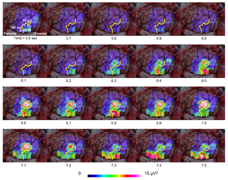 頭蓋内脳波を用いた、てんかん発作時の異常高周波活動の可視化技術